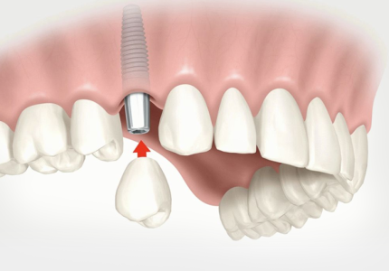Восстановление зубного ряда с помощью импланта. Плюсы услуги