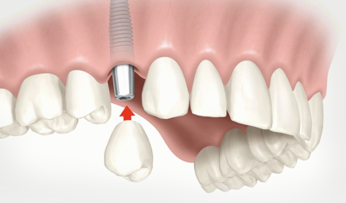 Восстановление зубного ряда с помощью импланта. Плюсы услуги