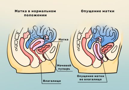 Реабилитация после операции при опущении матки